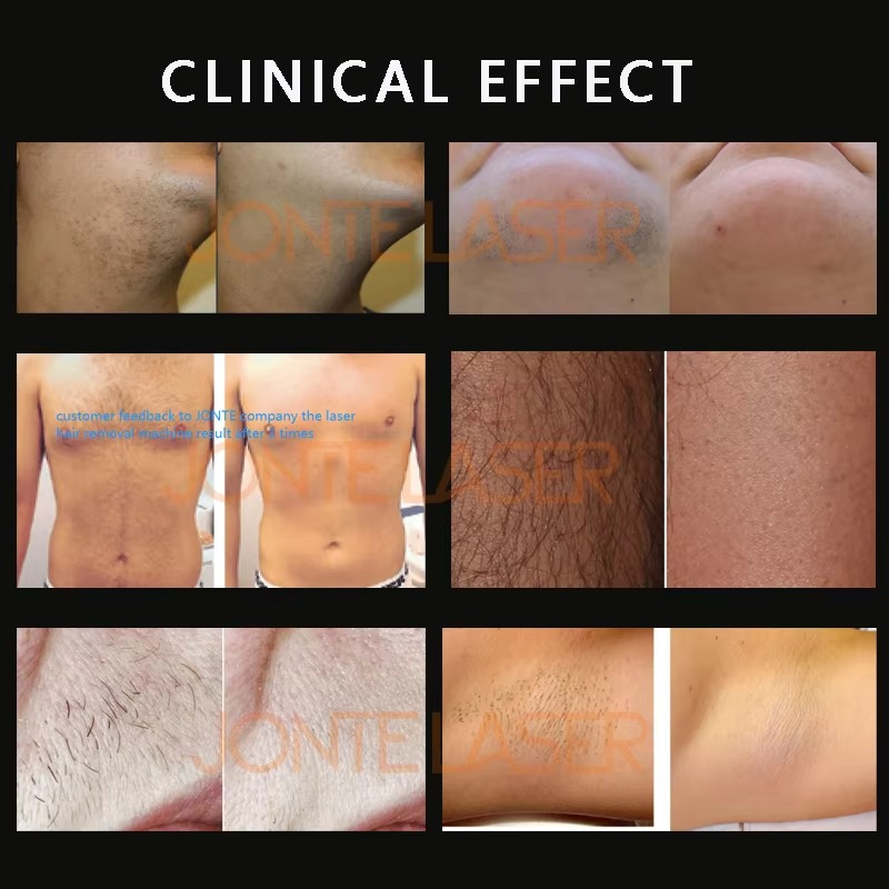 Máquina Portátil Profissional  - Diode Laser Hair Removal 808Nm 755Nm 1064Nm avaliação e preço