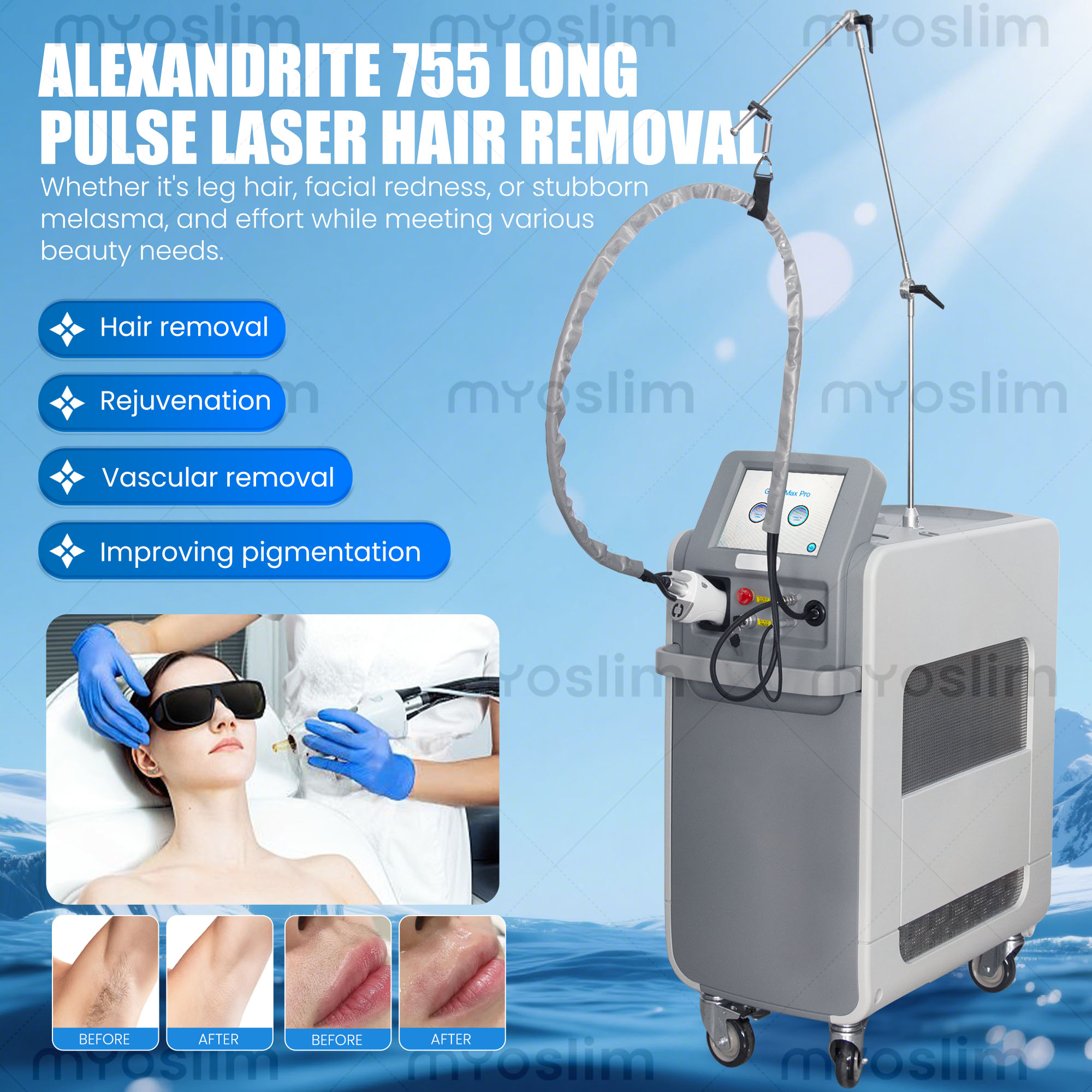 Máquina de Laser de Fibra Ópti - Alexandrite Laser Hair Removal Machine avaliação e preço